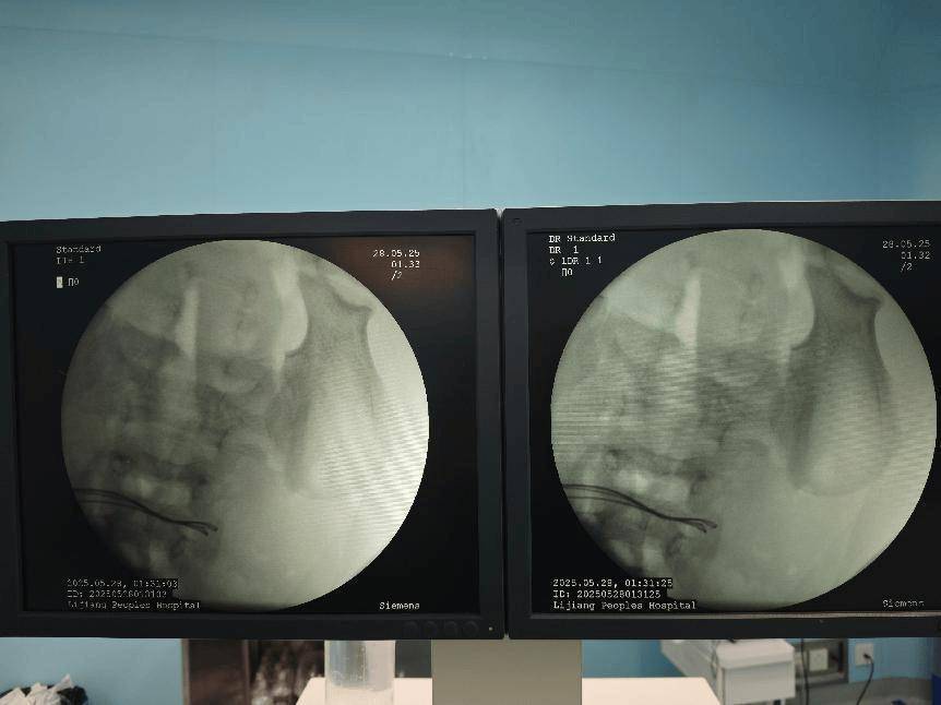 整整37颗！云南4岁孩子身体里取出……医生紧急提醒！