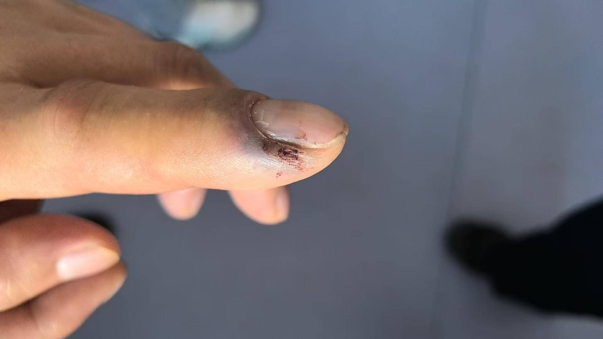 青海一男子被罕见剧毒阿拉善蝮蛇咬伤，因无血清一度想放弃治疗 警车开道转运700公里救命